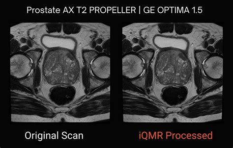 Utilizing Existing 1.5T MRI Prostate Scans | Medic Vision