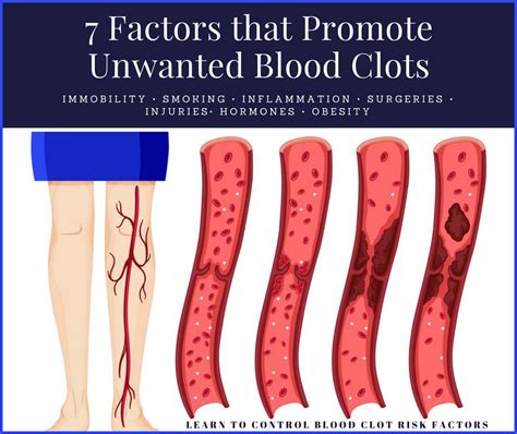 Tips for Blood Clot Prevention | Home Cures That Work