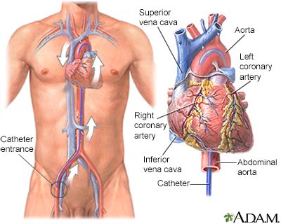 Cardiac catheterization Information | Mount Sinai - New York