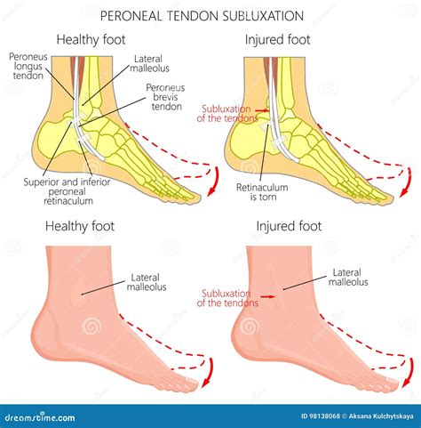 Peroneal Tendon Injuries_Peroneal Tendon Dislocation Stock Vector - Illustration of inversion ...