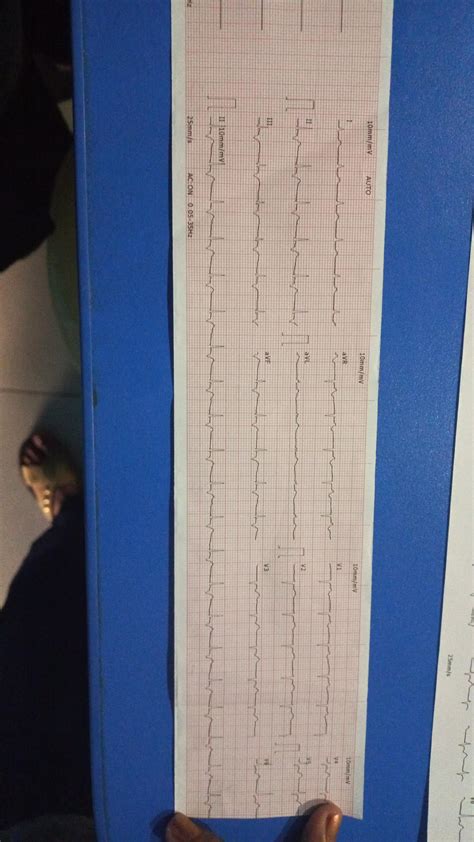 Junctional tachycardia? : r/Cardiology