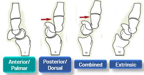 How to diagnose and treat a Palmar Midcarpal Instability