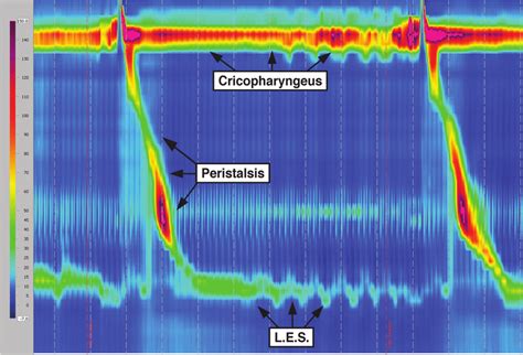 Spatiotemporal plot obtained during high-resolution manometry depicting ...