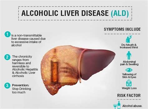 Alcohol Related Liver Disease - MEDizzy