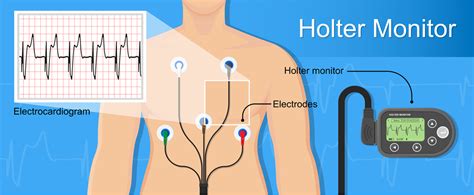 Holter heart monitor - grossmusical