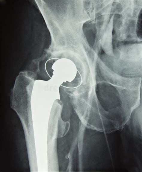 Hip Prosthesis Implant, Hip Replacement Stock Image - Image of femur ...