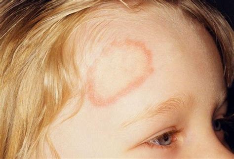 What causes ringworm? – What causes this?