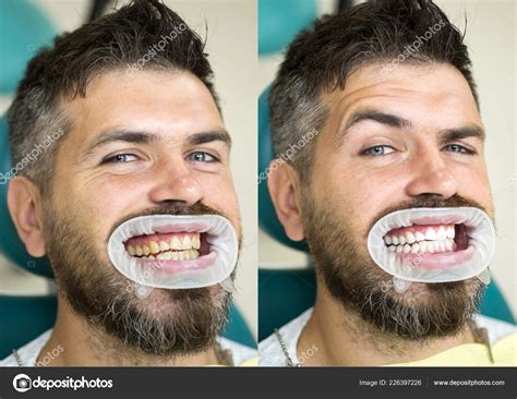 White teeth - before and after concept. Close-up detail of man teeth ...