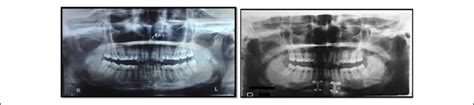 Preoperative and postoperative orthopantomogram. | Download Scientific Diagram