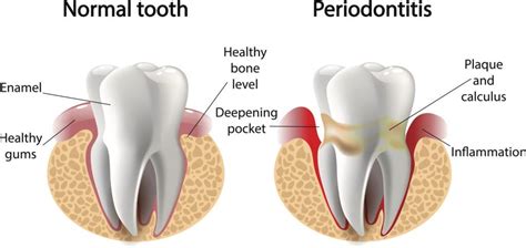 Bleeding Gums Burlington NC | Gum Disease | Gingivitis