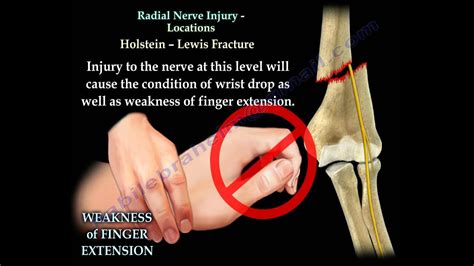 Posterior Interosseous Nerve Syndrome Vs Radial Tunnel Syndrome - Captions Profile