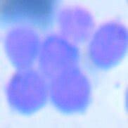 Showing comparative morphology of blast cell in sub-types of ALL. | Download Scientific Diagram