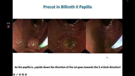 ERCP & Sphincterotomy in Billroth II Anatomy - YouTube