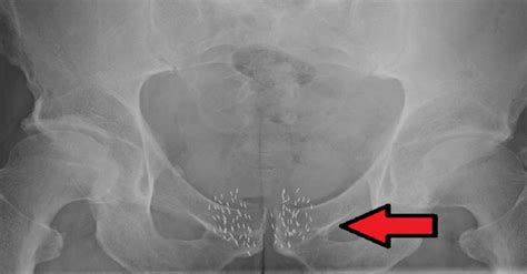 What is Brachytherapy? How does it help in Cancer Treatment?