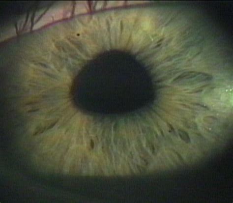 Adie's pupil. transillumination :: The University of Iowa, Ophthalmology