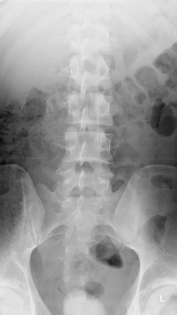 Lumbar Vertebrae Anatomy Xray