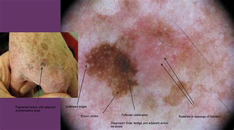 Dermoscopy Made Simple: Solar Lentigo