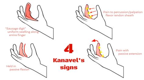 Infectious Flexor Tenosynovitis