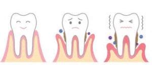 Causes of Tooth Mobility