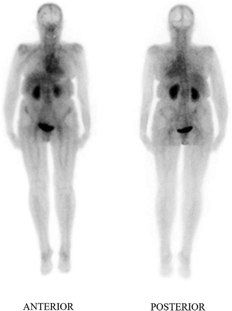 Iron Polymaltose Infusion Effects on Bone Scintigraphy and R... : Clinical Nuclear Medicine