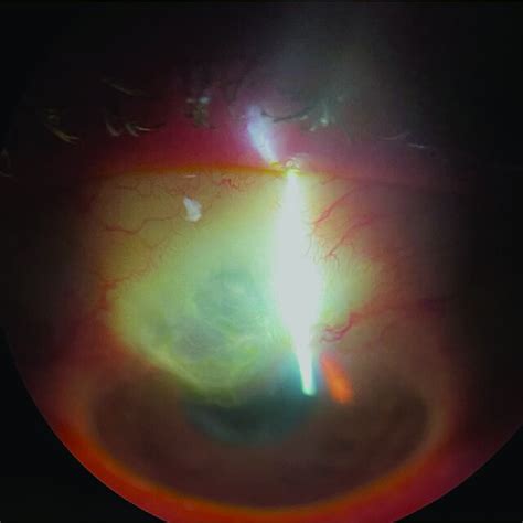 (PDF) Bleb Management Following Trabeculectomy and Glaucoma Drainage Device Implantation