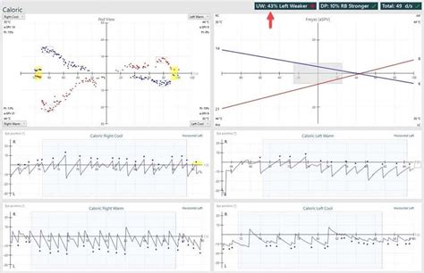 VisualEyes™ | Caloric Test | Interacoustics