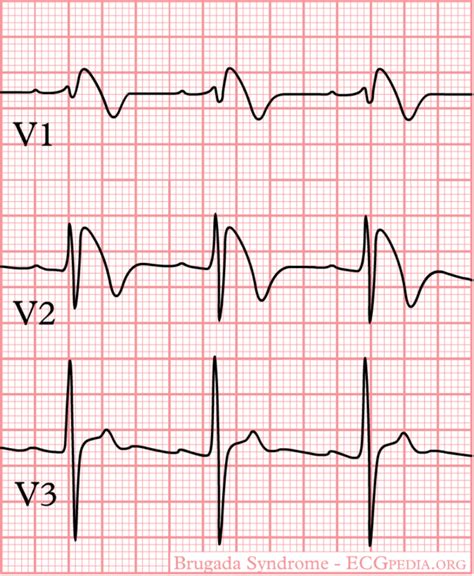 Brugada-syndroom - ECGpedia