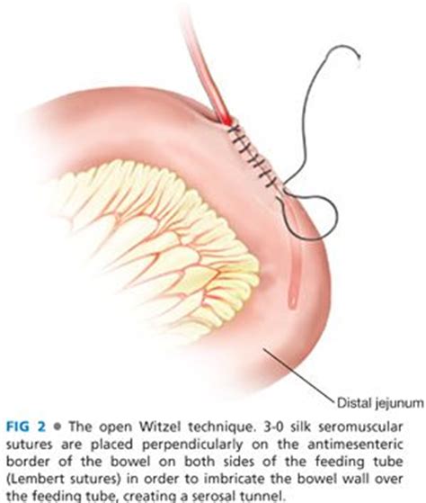 Jejunostomy Tube | Abdominal Key