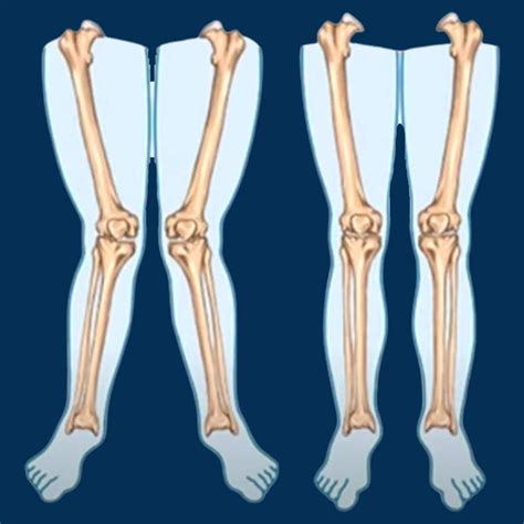 Knock Knee: Causes, Symptoms, Diagnosis and Treatment