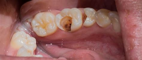 Great new information on the management of child dental decay - Kevin O'Brien's Orthodontic Blog