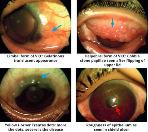 Vernal conjunctivitis, causes, symptoms, diagnosis, treatment & prognosis