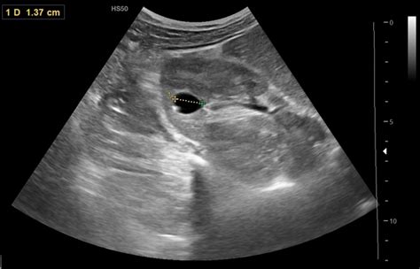 Renal Cyst Ultrasound