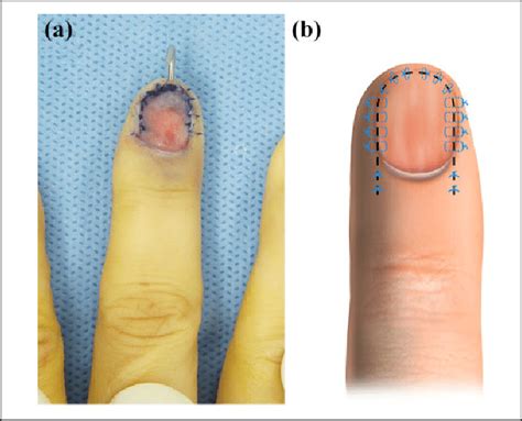 (a) The nail bed was repaired with absorbable sutures. (b) Horizontal ...