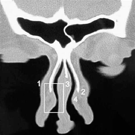 Coronal CT scan of nasal cavity at the osteomeatal complex. (1)... | Download Scientific Diagram