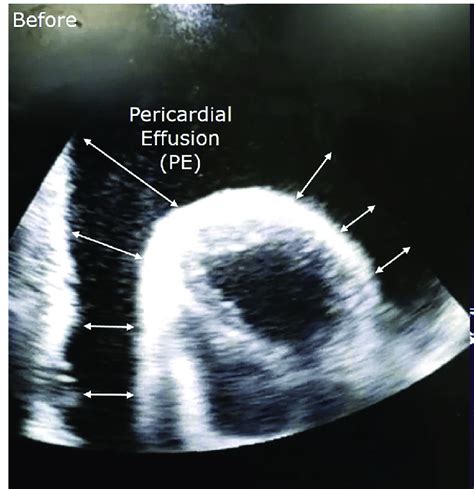 Echocardiogram showing massive pericardial effusion measuring 70 mm... | Download High-Quality ...