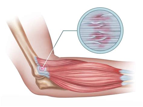 What You Need to Know About Scars Tissue After an Accident