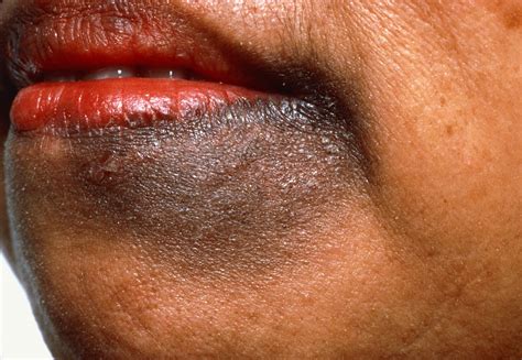 Common Skin Conditions in People of Color: Identification and Treatment - Dermatology Advisor