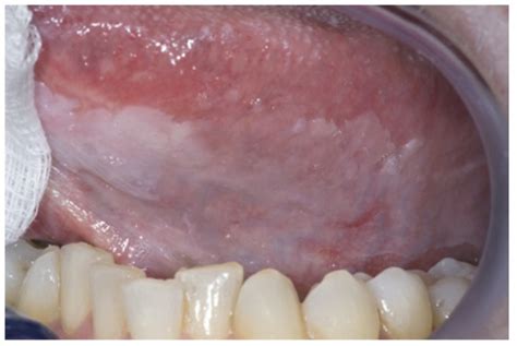 Cáncer Oral | Concise Medical Knowledge