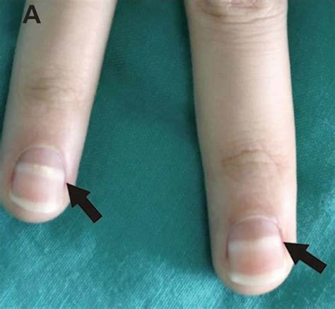 Mees lines fingernails causes, symptoms & treatment