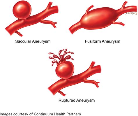 The Worst Headache of My Life: Aneurysmal Subarachnoid Hemorrhage - The ...