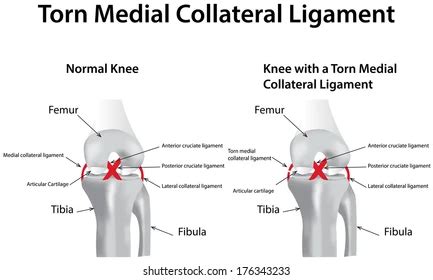 Medial Collateral Ligament (MCL) / Lateral Collateral Ligament (LCL ...