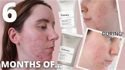 6 MONTHS OF....The Ordinary AZELAIC ACID & VITAMIN C Review | Acne, Pigmentation, Skin Texture ...