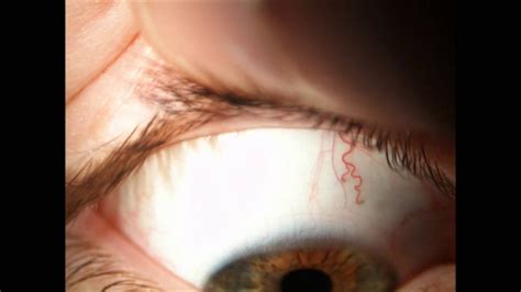 Contact Lenses - SCL Assessment of fit & Removal - YouTube