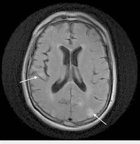 T2 FLAIR MRI of the brain with and without contrast. T2 fluid... | Download Scientific Diagram