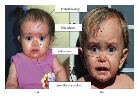 Comparison of facial features of the two patients: (a) the GHD type IA... | Download Scientific ...