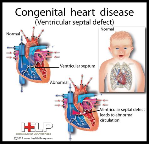 Pin by Lindsey Morrison on CHD | Congenital heart, Pediatric nursing, Congenital heart defect