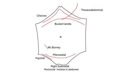 My notes: Its How I graduated Medical School.: Surgical Incision in ...