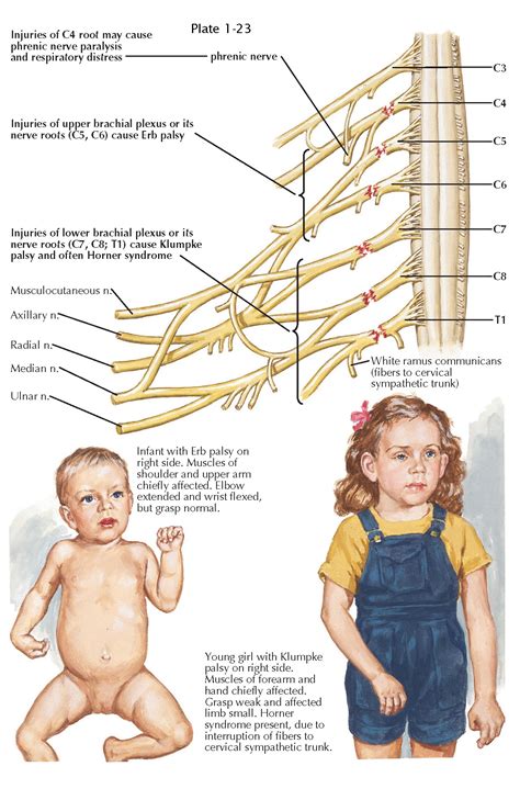 BRACHIAL PLEXUS AND/OR CERVICAL NERVE ROOT INJURIES AT BIRTH - pediagenosis