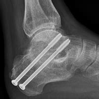 Subtalar Joint Arthritis - Arthrodesis | Stirling | Nedlands