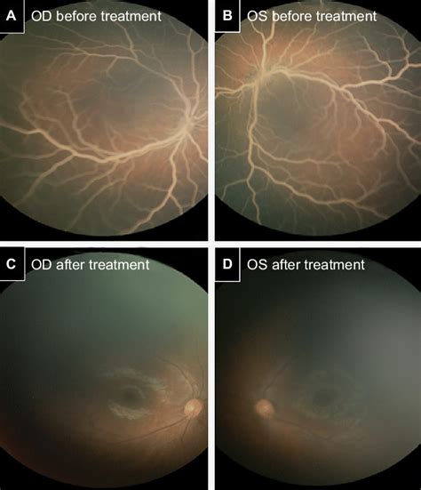 Lipemia retinalis before and after treatment. Fundus examination... | Download Scientific Diagram